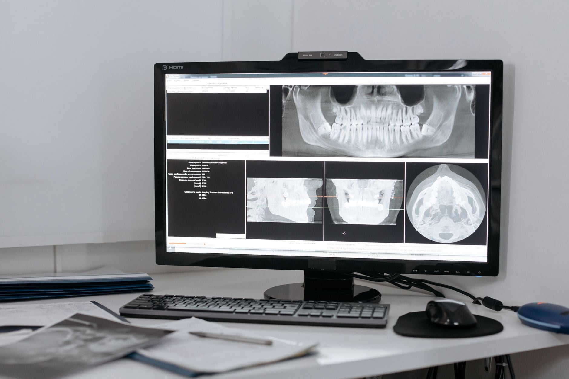 A dental X-ray on a screen